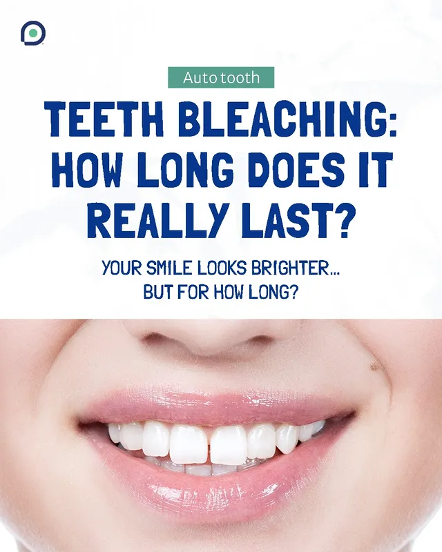 Berapa Lama Bleaching Gigi Bertahan?